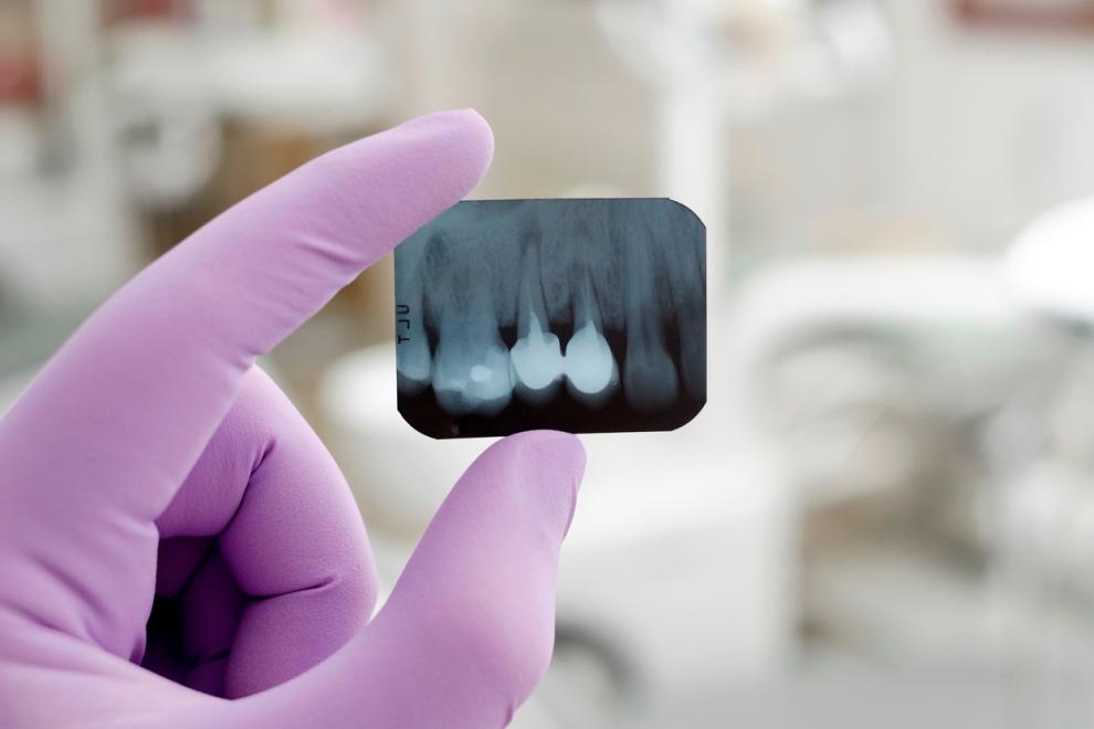 rx dental, rx odontologia, radiografia dentista